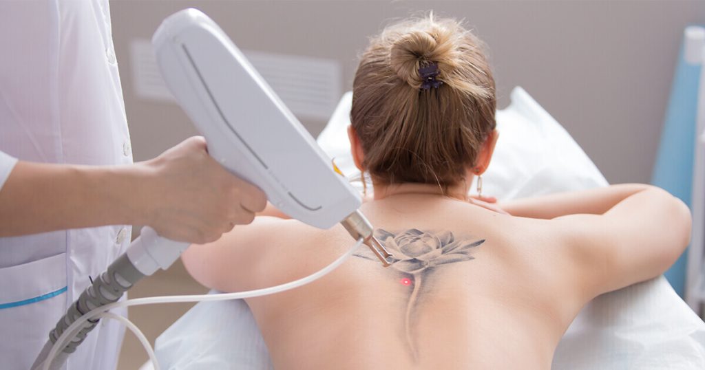 Tattoo Removal